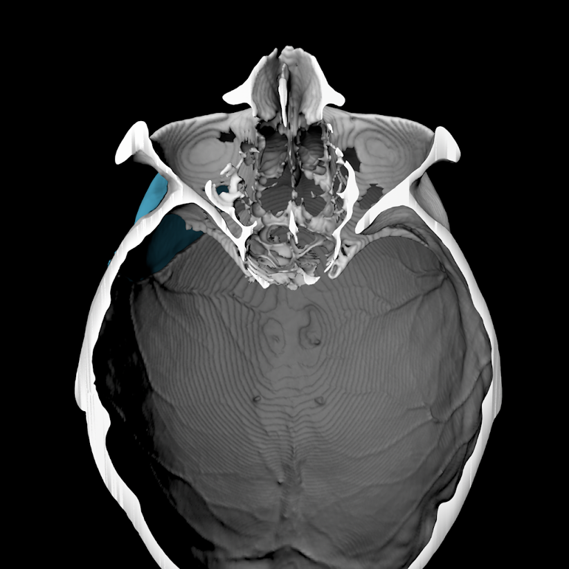 3D Craniotomy Model